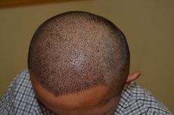 -大麦微针植发丨全国连锁