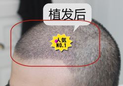 -大麦微针植发全国连锁