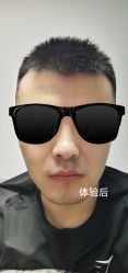 点击看大图 体验后-青岛诺德医学美容医院