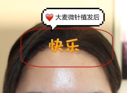 -大麦微针植发全国连锁