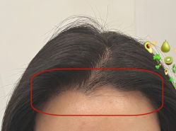 -大麦微针植发全国连锁