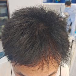 -大麦微针植发全国连锁