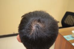 -大麦微针植发丨全国连锁