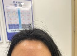 体验后-大麦微针植发全国连锁