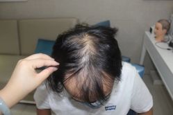 点击看大图 -大麦微针植发全国连锁