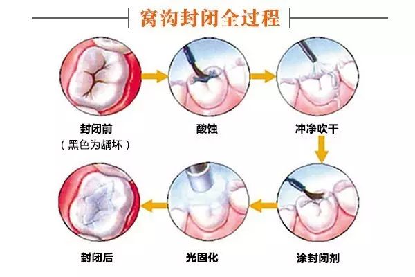 六龄牙有几颗图片