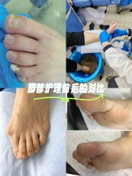 -德哥灰指甲脚气甲沟炎跖疣护理