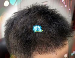 -大麦微针植发全国连锁