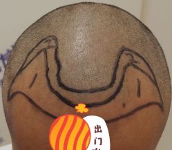 -大麦微针植发全国连锁