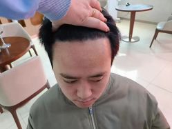 点击看大图 体验后-大麦微针植发丨全国连锁