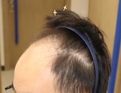 -大麦微针植发全国连锁