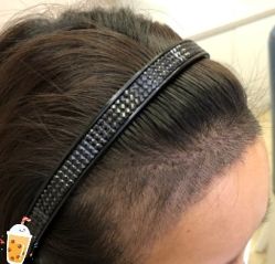 -大麦微针植发丨全国连锁