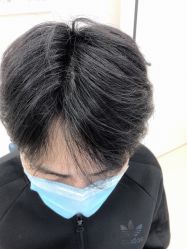 点击看大图 -大麦微针植发丨全国连锁