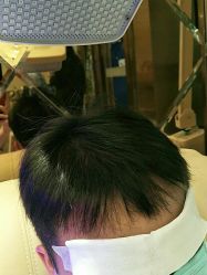 点击看大图 -碧莲盛·不剃发植发