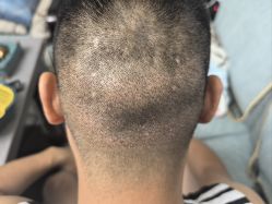 -碧莲盛·不剃发植发