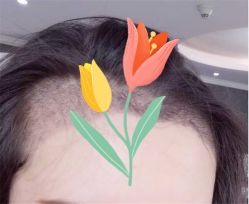 点击看大图 -大麦微针植发全国连锁