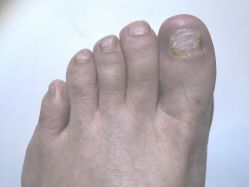 第四周-派恩宜灰指甲鸡眼嵌甲手足癣