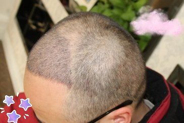 -大麦微针植发丨全国连锁