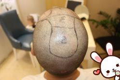 -大麦微针植发丨全国连锁