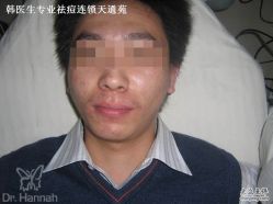 -韩医生专业祛痘连锁机构