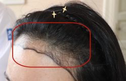 -大麦微针植发全国连锁