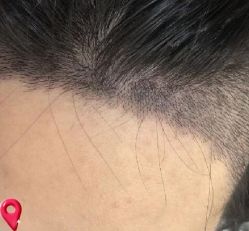 -大麦微针植发丨全国连锁