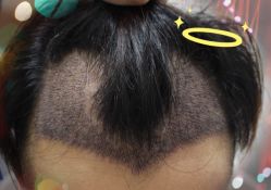 -大麦微针植发全国连锁