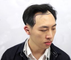 -大麦微针植发丨全国连锁