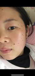 点击看大图 -北京美痣堂古方祛痣斑疣瘊