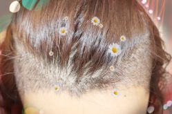 -大麦微针植发全国连锁