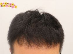 -大麦微针植发全国连锁
