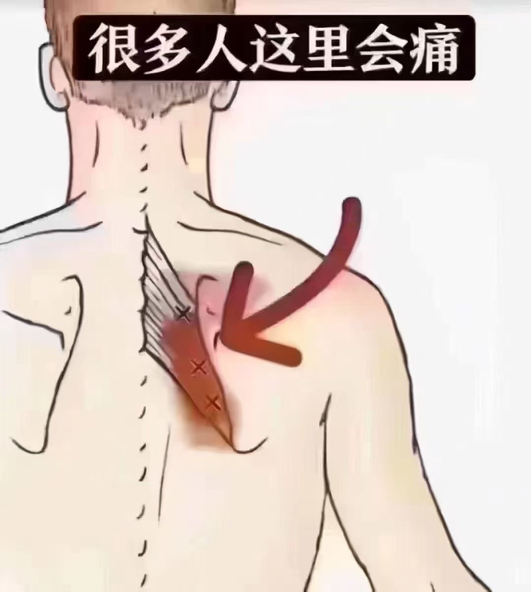 肩胛骨缝为什么会痛?因为所有的肝毒在这里藏着
