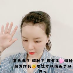 -碧莲盛·不剃发植发