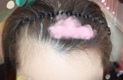 -大麦微针植发全国连锁