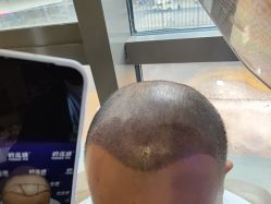 -碧莲盛·不剃发植发