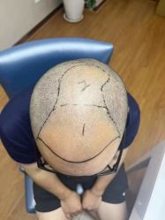 -大麦微针植发全国连锁