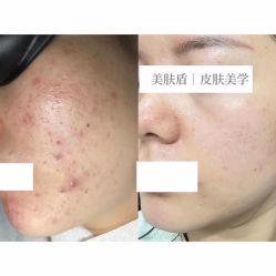 -美肤盾祛痘·问题肌头疗管理中心
