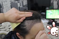 -大麦微针植发丨全国连锁