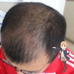 -大麦微针植发丨全国连锁