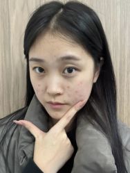 -成都苗方清颜专业祛痘