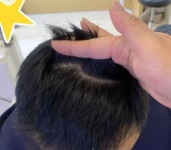 -大麦微针植发丨全国连锁