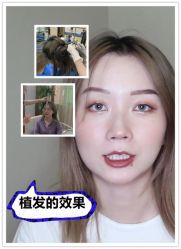 -碧莲盛·不剃发植发