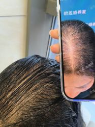 -碧莲盛·不剃发植发