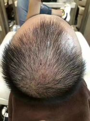 -大麦微针植发全国连锁