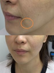 -海涛医疗美容·面部抗衰·注射美鼻