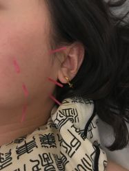 -肥三针腧穴瘦身馆