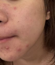 -倩极·精研痘敏肌管理