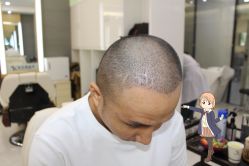 -大麦微针植发丨全国连锁