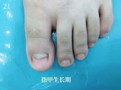 -德哥灰指甲脚气甲沟炎跖疣护理