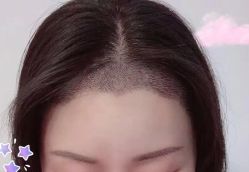 -大麦微针植发丨全国连锁